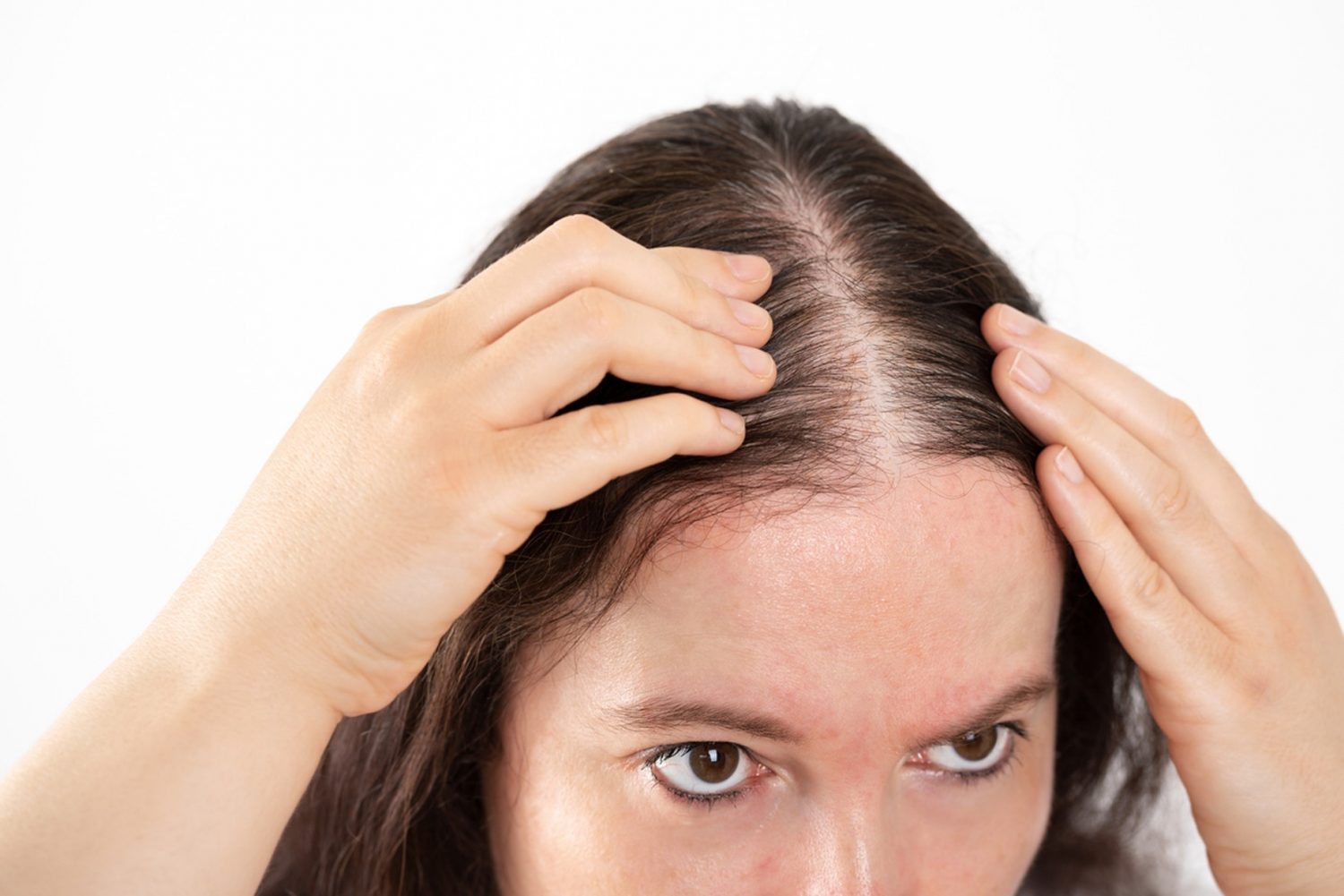 Top More Than 68 Female Hair Thinning Best In Eteachers